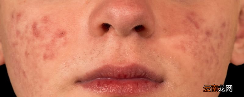 烟酰胺去痘印 烟酰胺怎么去痘印