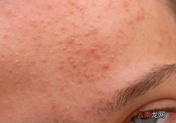 烟酰胺去痘印 烟酰胺怎么去痘印