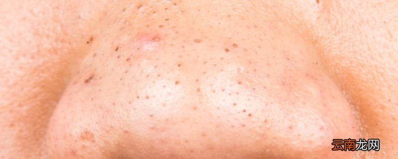 黑头去不掉怎么办 如何正确去黑头