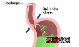 良性食道癌什么症状 良性食道癌的症状分析详解