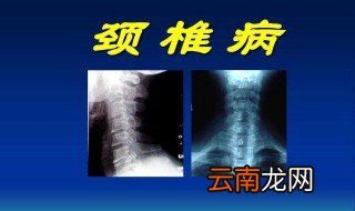 颈椎病对身体的危害 危害是不是很大呢