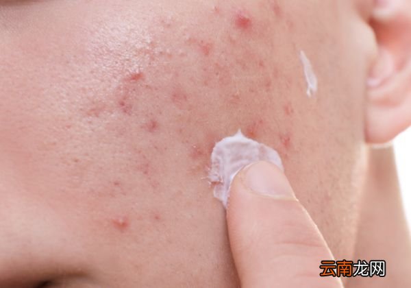 祛痘护肤品的效果有哪些 祛痘护肤品推荐