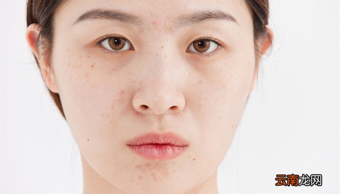 生姜擦脸可以祛痘吗 生姜涂脸可以祛痘吗