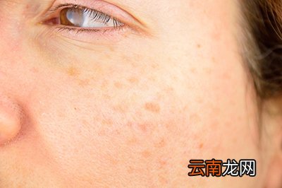 脸上为什么有斑 脸上长斑的原因