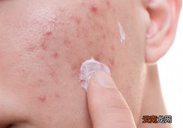 封闭性粉刺是什么 封闭性粉刺形成的原因