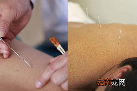针灸减肥20斤需要多久 平时多运动很关键