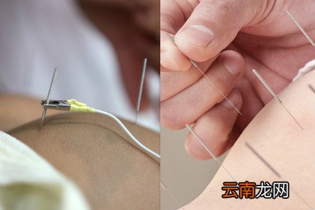 针灸减肥20斤需要多久 平时多运动很关键