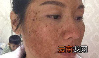 排黑色素的简单方法 排黑色素的简单方法是什么
