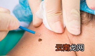 双生痣是什么意思 双生痣的解释