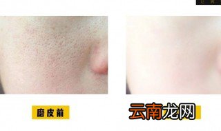 收缩毛孔的方法 收缩毛孔这三个办法好
