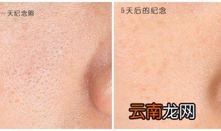 怎么收缩毛孔 收缩毛孔这三个办法好