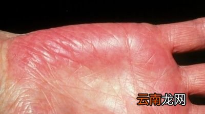 肝病早期有哪些症状呢