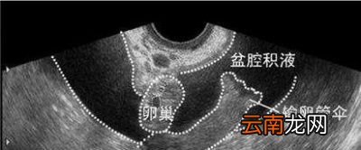 盆腔有积液是什么原因