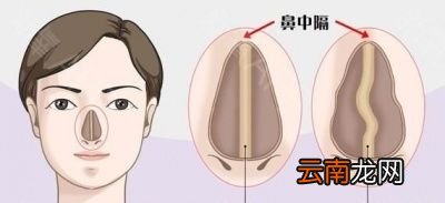 鼻中隔偏曲的检查项目有哪些