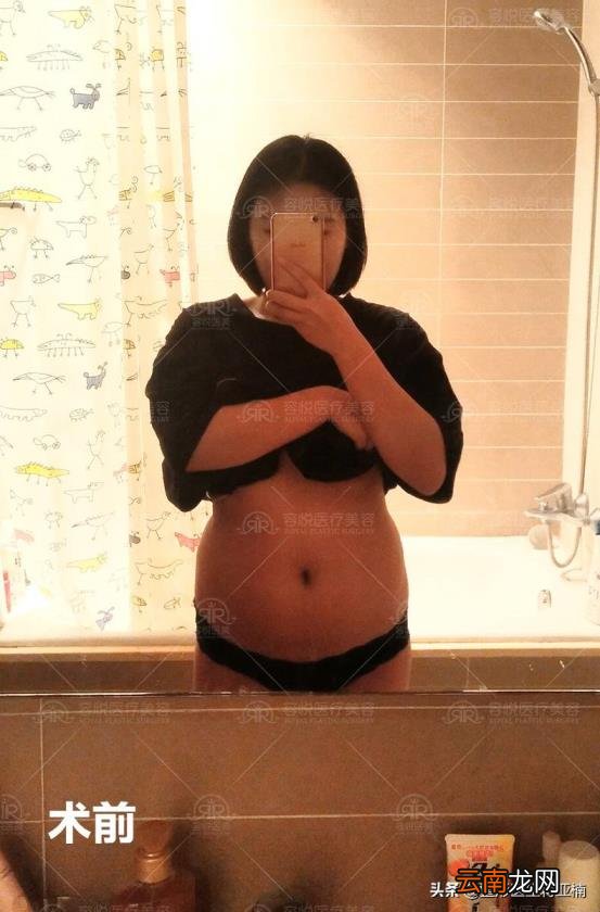 抽脂手术的价位 抽脂得多少钱