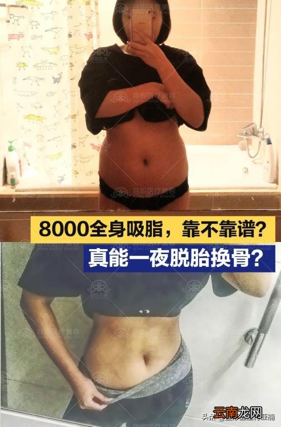 抽脂手术的价位 抽脂得多少钱