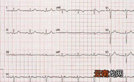 二十四小时心电图禁忌 心电图多少钱