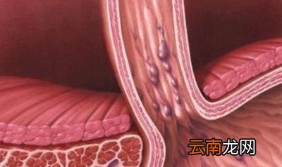 什么情况下连续吃笋会引起上消化道大出血