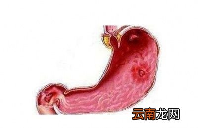 什么情况下连续吃笋会引起上消化道大出血