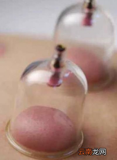 怎样才能有效的祛除湿气拔血罐真的管用吗