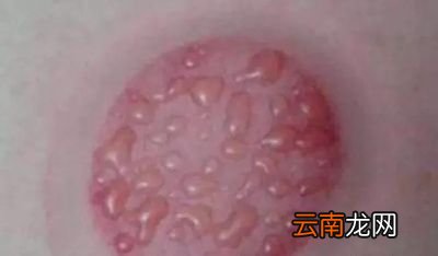 怎样才能有效的祛除湿气拔血罐真的管用吗