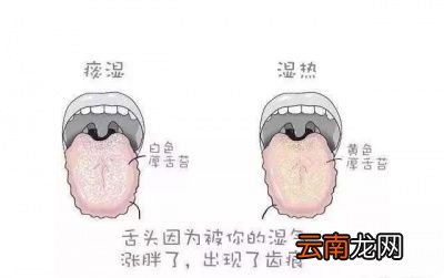 怎样才能有效的去除湿气拔血罐真的管用吗