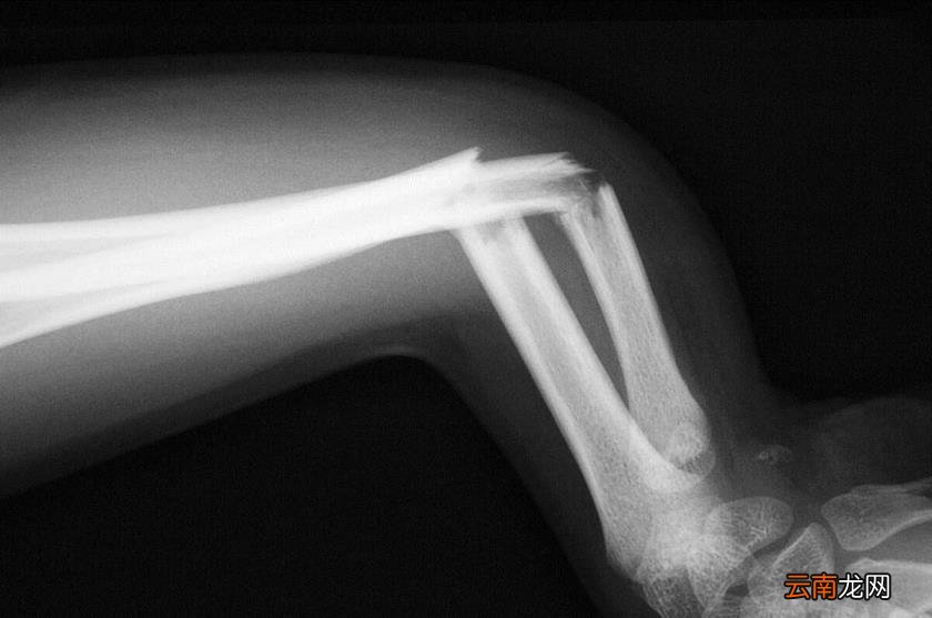 人手骨头图片 人有多少块骨头