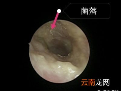 耳屎对耳朵有好处吗