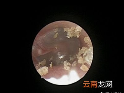 耳屎对耳朵有好处吗