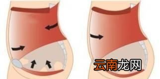 怎样正确进行提肛运动