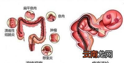 肠镜检查前要做哪些准备