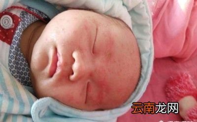 哺乳期吃香椿注意事项