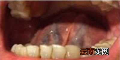 青筋发黑什么情况
