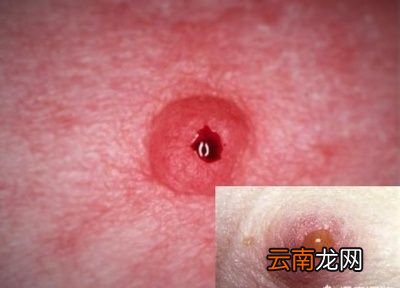 乳头溢液都是乳腺癌吗