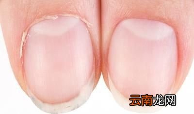 如何避免脚趾甲长到肉