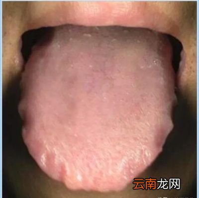 体内湿气重拔罐会出现水泡吗需要注意什么