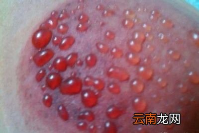 体内湿气重拔罐会出现水泡吗需要注意什么