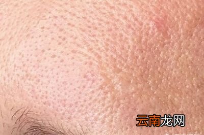 毛孔粗大的3大原因