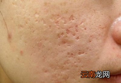 脸颊毛孔粗大是怎么来的
