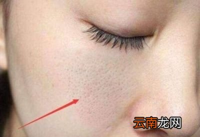 脸颊毛孔粗大是怎么来的