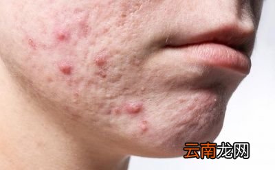 男性如何祛湿快