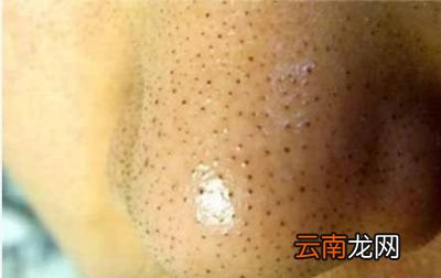 但是有黑头没办法根治怎么办呢