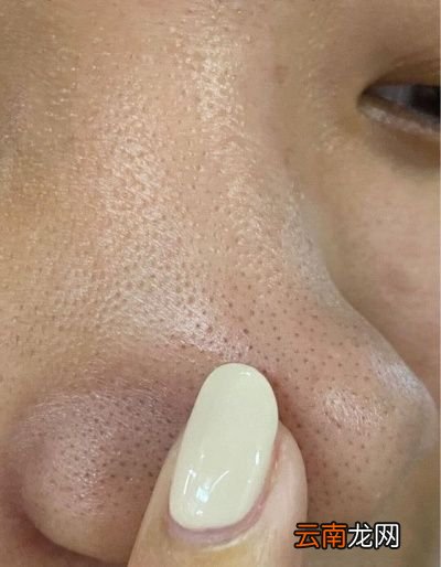 黑头挤出来的白色东西是什么