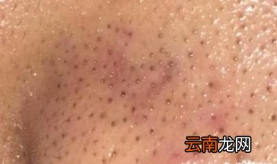 黑头是怎么形成的为什么总是挤了又长