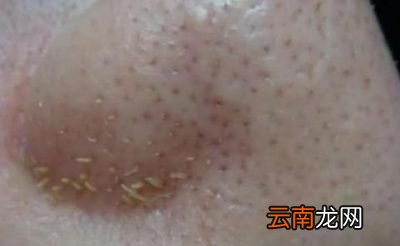 黑头是怎么形成的为什么总是挤了又长