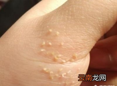 黑头是怎么形成的