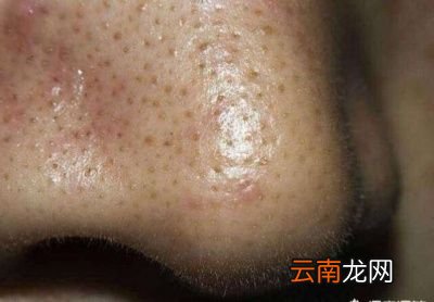黑头是怎么形成的