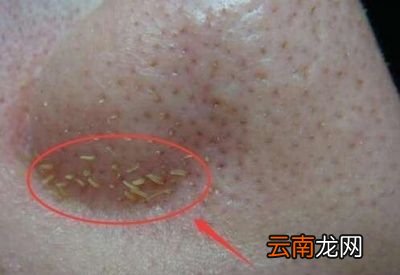 黑头里面挤出来的颗粒物是什么东西