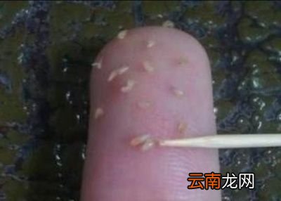 黑头里面挤出来的颗粒物是什么东西