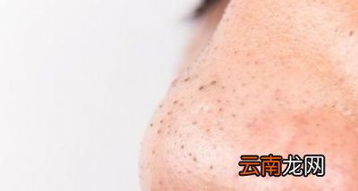 黑头里面挤出来的颗粒物是什么东西